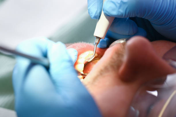 Best Emergency Tooth Extraction in Red Oak, TX